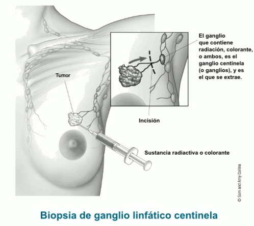 biopsiadeganglio